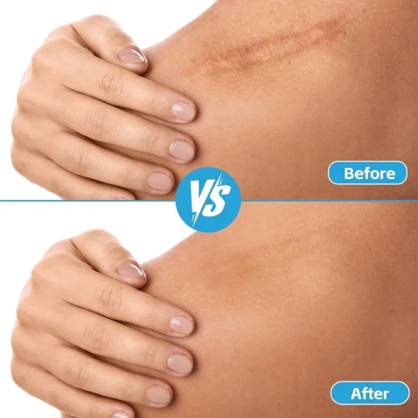 Hydrocolloid Wound Care Tape Roll